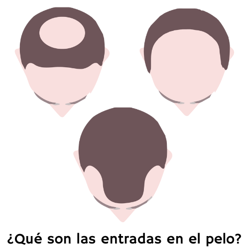 que son las entradas en el pelo
